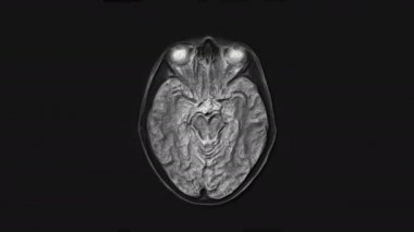 Voluminöz MR beyin, kafa taraması ve tümör tespiti. Teşhis medikal aracı