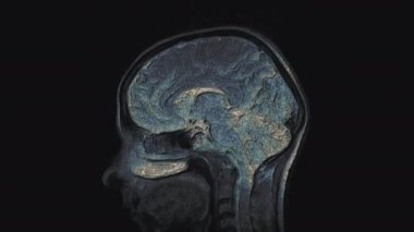 Çoklu renkli MRI beyni, kafa taraması ve tümör tespiti. Teşhis medikal aracı