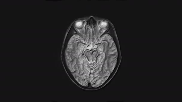 Ressonância magnética volumosa cérebro, cabeça e detecção de tumores. Ferramenta médica de diagnóstico — Vídeo de Stock