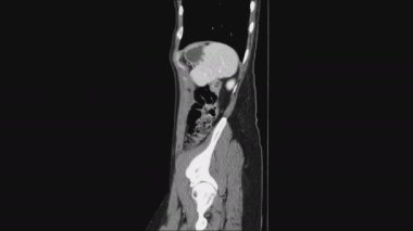 Kadın pelvik organlarının MR 'ı, karın boşluğu, gastrointestinal bölge ve mesane.
