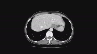 Kadın pelvik organlarının MR 'ı, karın boşluğu, gastrointestinal bölge ve mesane.