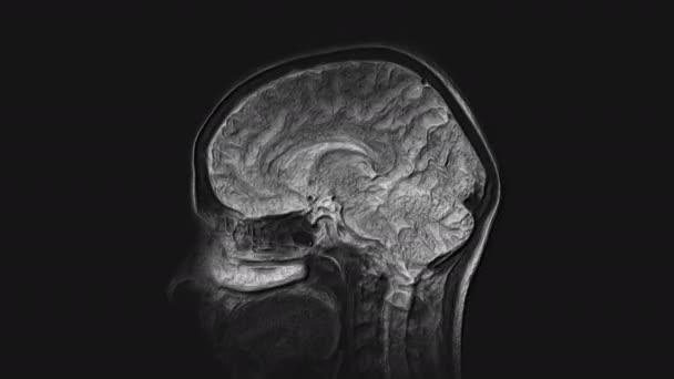 Resonancia magnética cerebral voluminosa, escáneres de cabeza y detección de tumores. Herramienta médica de diagnóstico — Vídeos de Stock