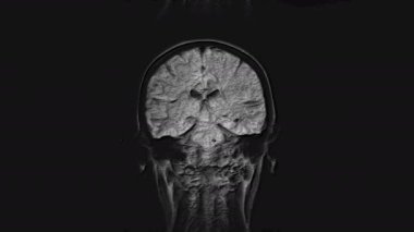 Voluminöz MR beyin, kafa taraması ve tümör tespiti. Teşhis medikal aracı