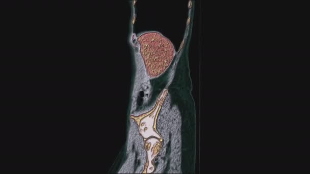 Sebagian besar diwarnai MRI dari organ panggul perempuan, rongga perut, saluran pencernaan dan kandung kemih — Stok Video