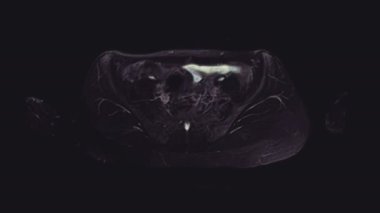 Kadın pelvis organlarının, karın boşluğunun, bağırsak yolunun ve mesanenin çok renkli MR 'ı.