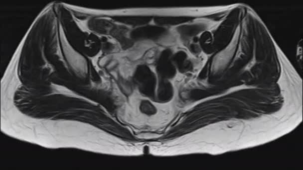 MRI żeńskich narządów miednicy, jamy brzusznej, przewodu pokarmowego i pęcherza moczowego — Wideo stockowe