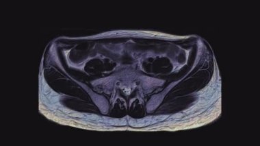Kadın pelvis organlarının, karın boşluğunun, bağırsak yolunun ve mesanenin çok renkli MR 'ı.