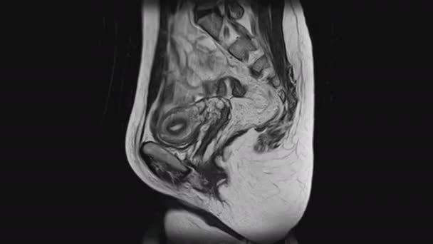 MRI of the female pelvic organs, abdominal cavity, gastrointestinal tract and bladder — Stock Footage MRI of the female pelvic organs, abdominal cavity, gastrointestinal tract and bladder Video Clip