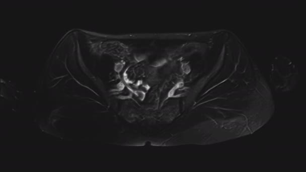 Resonancia magnética voluminosa de los órganos pélvicos femeninos, cavidad abdominal, tracto gastrointestinal y vejiga — Vídeo de stock