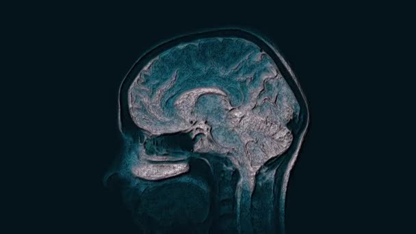 Resonancia magnética de color voluminoso cerebro, escáneres de cabeza y detección de tumores. Herramienta médica de diagnóstico — Vídeo de stock