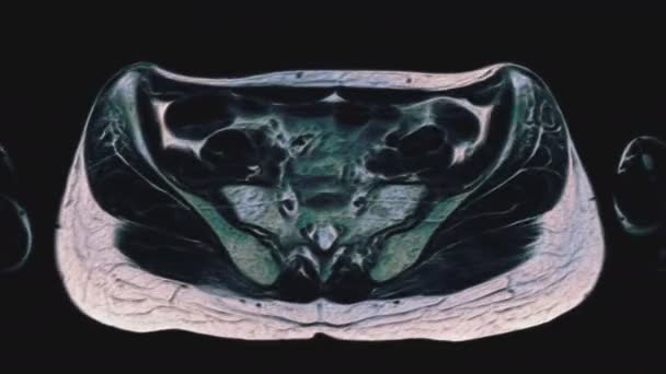 Bulk multicolored MRI of the female pelvic organs, abdominal cavity, gastrointestinal tract and bladder — Stock Footage Bulk multicolored MRI of the female pelvic organs, abdominal cavity, gastrointestinal tract and bladder Stock Video