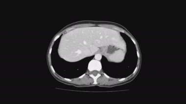 Kadın pelvik organlarının MR 'ı, karın boşluğu, gastrointestinal bölge ve mesane.