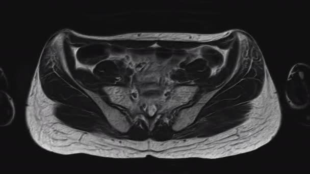 Objemná MRI ženských pánevních orgánů, břišní dutiny, gastrointestinálního traktu a močového měchýře — Stock video