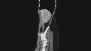 Kadın pelvik organlarının voluminöz MR 'ı, karın boşluğu, gastrointestinal bölge ve mesane.
