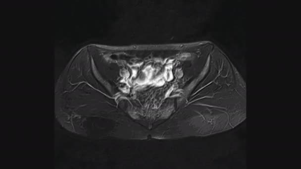 Objętościowe MRI żeńskich narządów miednicy, jamy brzusznej, przewodu pokarmowego i pęcherza moczowego — Wideo stockowe