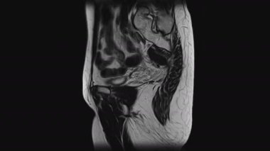 Kadın pelvik organlarının MR 'ı, karın boşluğu, gastrointestinal bölge ve mesane.