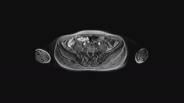 Resonancia magnética de los órganos pélvicos femeninos, cavidad abdominal, tracto gastrointestinal y vejiga — Vídeos de Stock