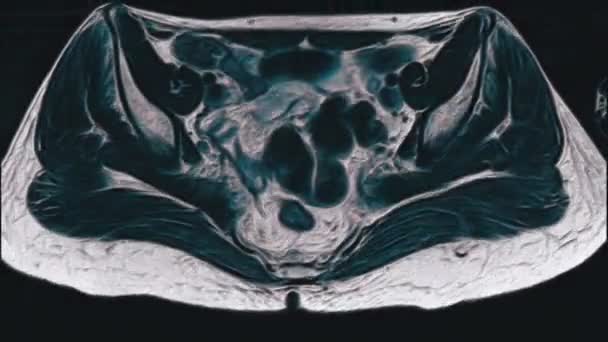 Warna cerah MRI dari organ panggul wanita, rongga perut, saluran pencernaan dan kandung kemih — Stok Video