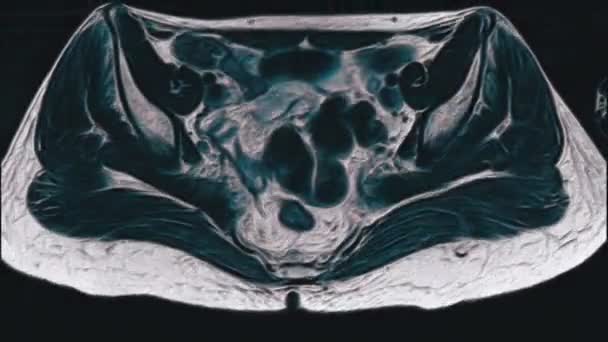 Voluminous color MRI of the female pelvic organs, abdominal cavity, gastrointestinal tract and bladder — Stock Footage Voluminous color MRI of the female pelvic organs, abdominal cavity, gastrointestinal tract and bladder Royalty Free Stock Footage