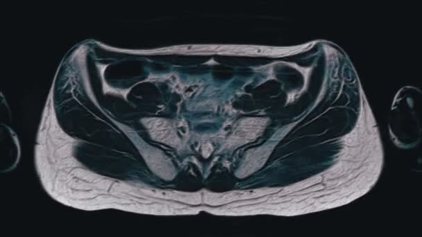 女性盆腔、腹腔、胃肠道及膀胱的彩色MRI检查 — 图库视频影像