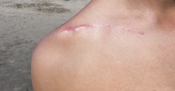 skapula omuz üzerinde cerrahi yara