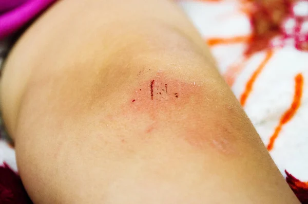 Anak Dengan Lutut Terluka Images Libres De Droit Photos De Anak Dengan Lutut Terluka Depositphotos