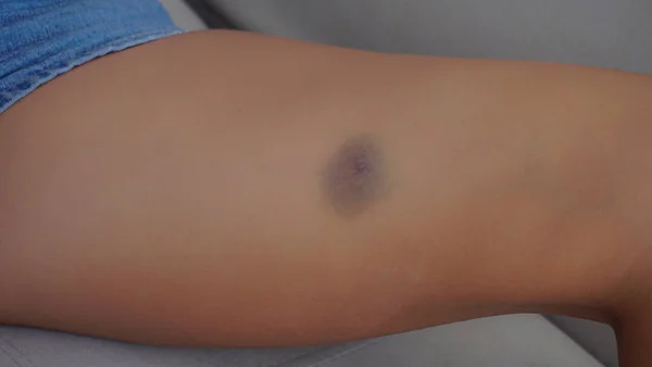 Bruise Bruise Girl Thigh — Stock Photo, Image