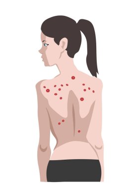 Cilt sorunları, sırt akne, akne ile genç kız