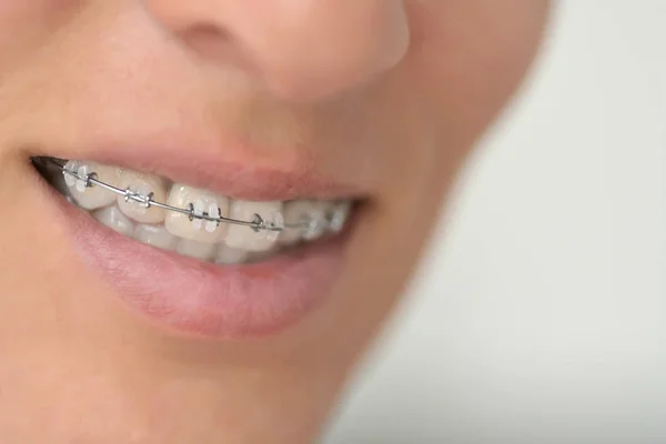 Système d'attelles dans la bouche souriante, macro photo dents, lèvres rapprochées — Photo
