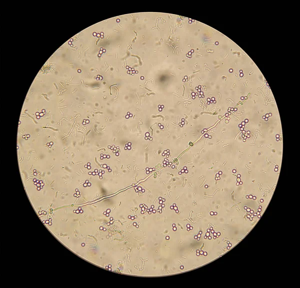原生制剂中白色念珠菌真菌的微观观察 — 图库照片