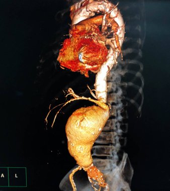 Abdominal aort anevrizması