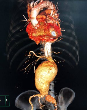 Abdominal aort anevrizması