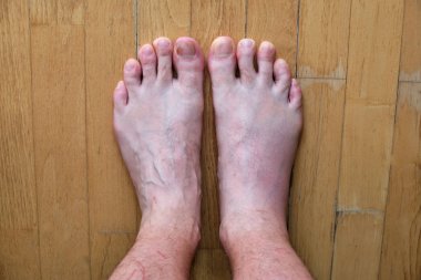 Erkek sağ ayak yaban arı sokması sonra şişmiş, yan yana ve normal görünümlü sol ayak ile karşılaştırıldığında.