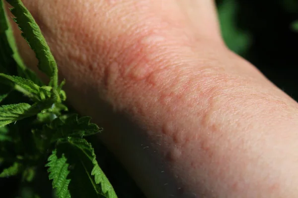 Brennnesseln Und Ein Arm Mit Brennnesselstichen — Stockfoto