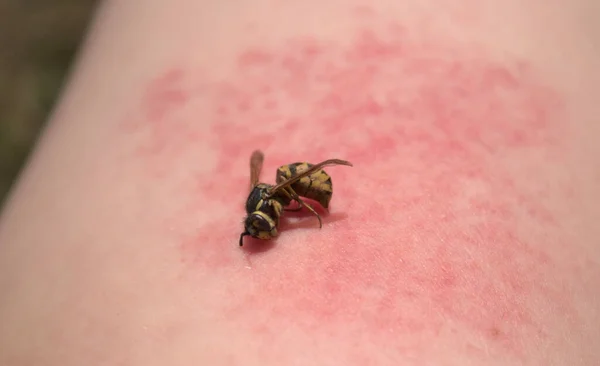 Una Avispa Brazo Con Una Picadura Avispa —  Fotos de Stock