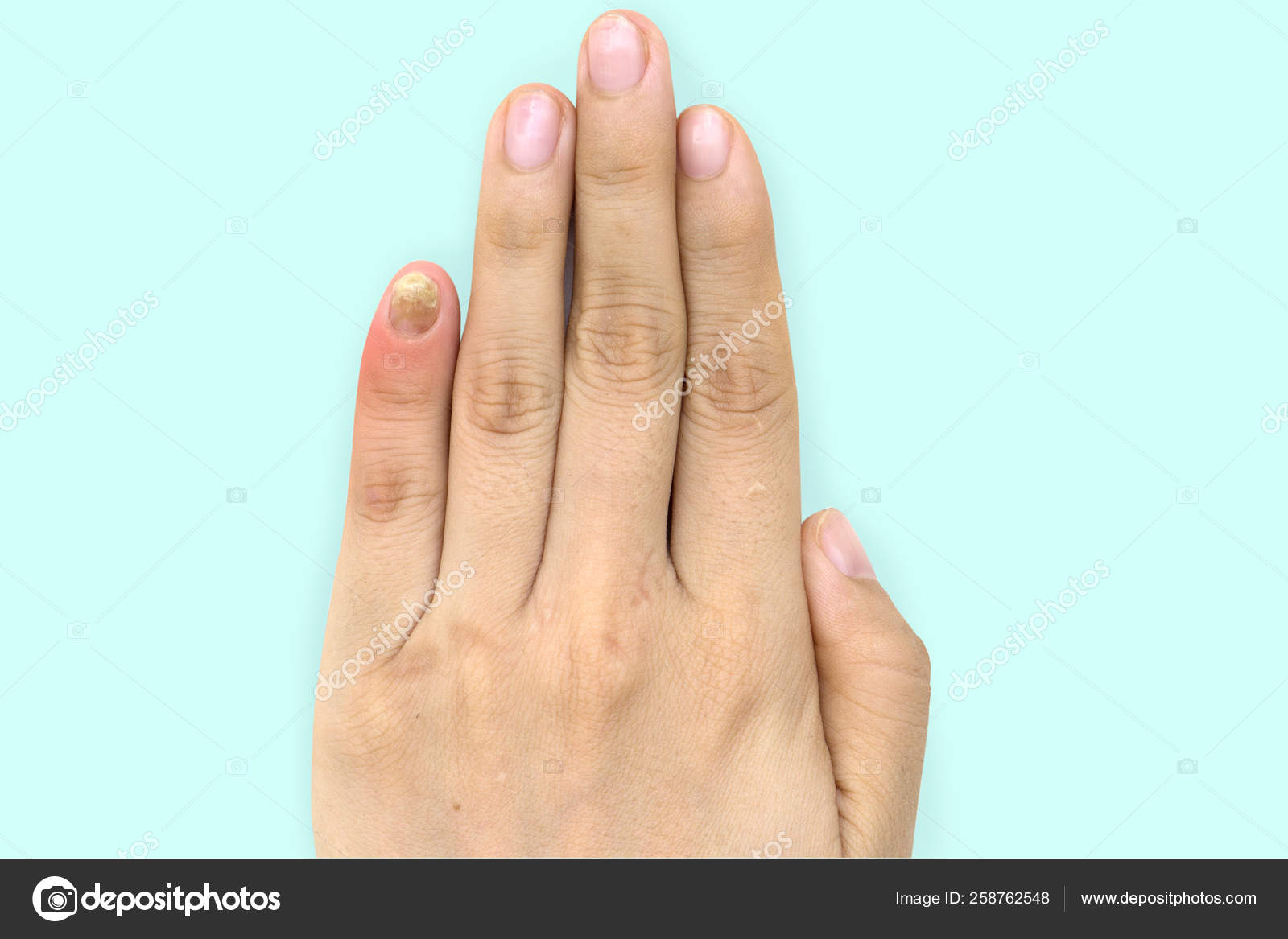 Fungus, Closeup nail fungus infection on hand finger of white caucasian  woman. Fungal infection on nail, female hand finger with onychomycosis.  health Stock Photo - Alamy