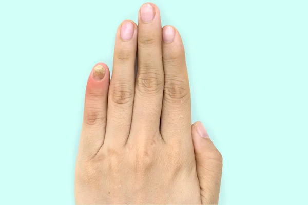 Close up of nail fungus infection on the little finger. Human hand suffering from fungus infection. Onychomycosis with fungal nail infection on nail isolated over soft background. Clipping path. — Stock Image Close Nail Fungus Infection Little Finger Human Hand Suffering Fungus Stock Image
