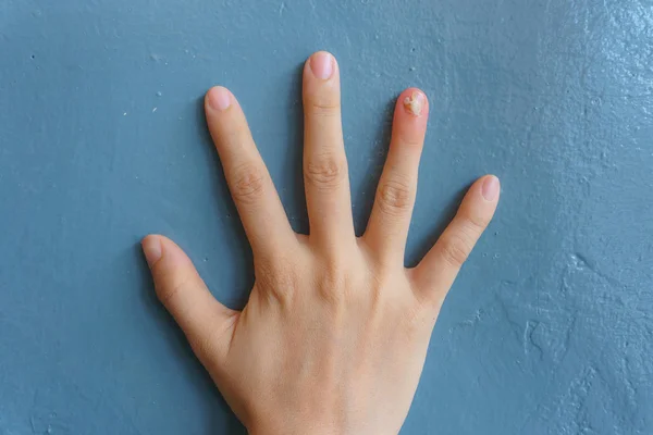 薬指の爪真菌感染のクローズアップ 真菌感染に苦しむ人間の手 青い背景の上に爪に真菌爪感染症を持つオニコ真菌症 — ストック写真