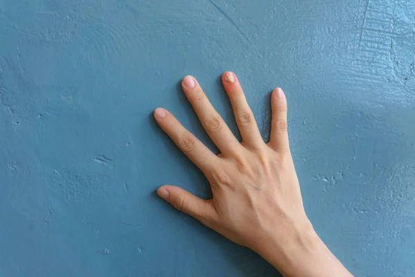 小指の爪真菌感染のクローズアップ 真菌感染に苦しむ人間の手 — ストック写真
