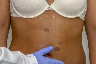 Afrika olan kadın Doğum lekesi sırt derisi üzerinde. İyi huylu benler kontrol