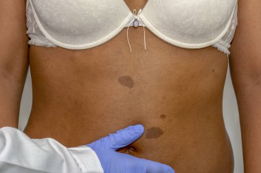 Young african woman with birthmark on her back skin. Checking benign moles clipart