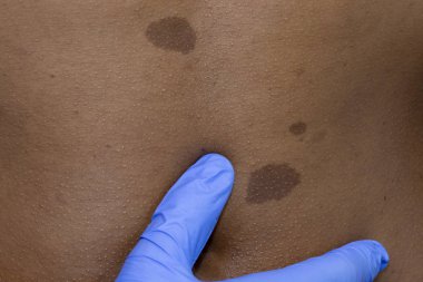 Doctor dermatologist examines  Young african woman with moles birthmark on her tummy, Checking benign moles. Neurofibromatosis  clipart