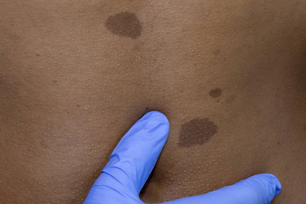 Dermatólogo Médico Examina Mujer Africana Joven Con Lunares Marca Nacimiento — Foto de Stock