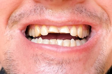 İnsan ağzında hasarlı ve kırık ön dişler. Diş sağlığı sorunu, ağız temizliği sorunu, diş bozukluğuna yakından bakma.