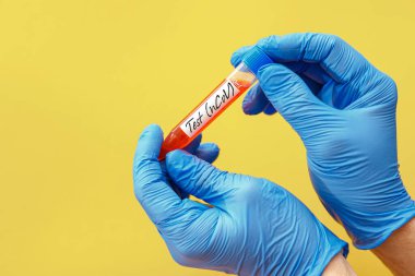 COVID-19 testi için kan örneğiyle test tüpü, yeni Coronavirüs 2019