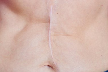 Cerrahi bir ameliyattan sonra kusursuz bir kusur.