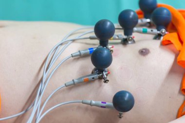 Elektrokardiyogram için elektrodları olan bir hastanın EKG 'si ya da EKG' si hastanede yatıyor..