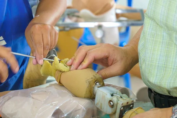 Medical Technician Make New Aluminium Prosthesis Legs Amputee Patient — Stock Photo, Image