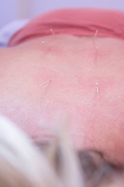 Sırtında altı tane akupunktur iğnesi olan tanınmayan bir kadının sırtında, omurgasının yanında. Seçici odak