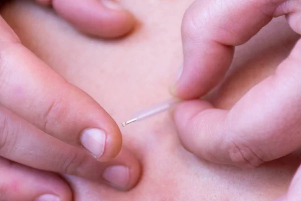 Mains Une Femme Plaçant Une Aiguille Acupuncture Sur Dos Une — Photo